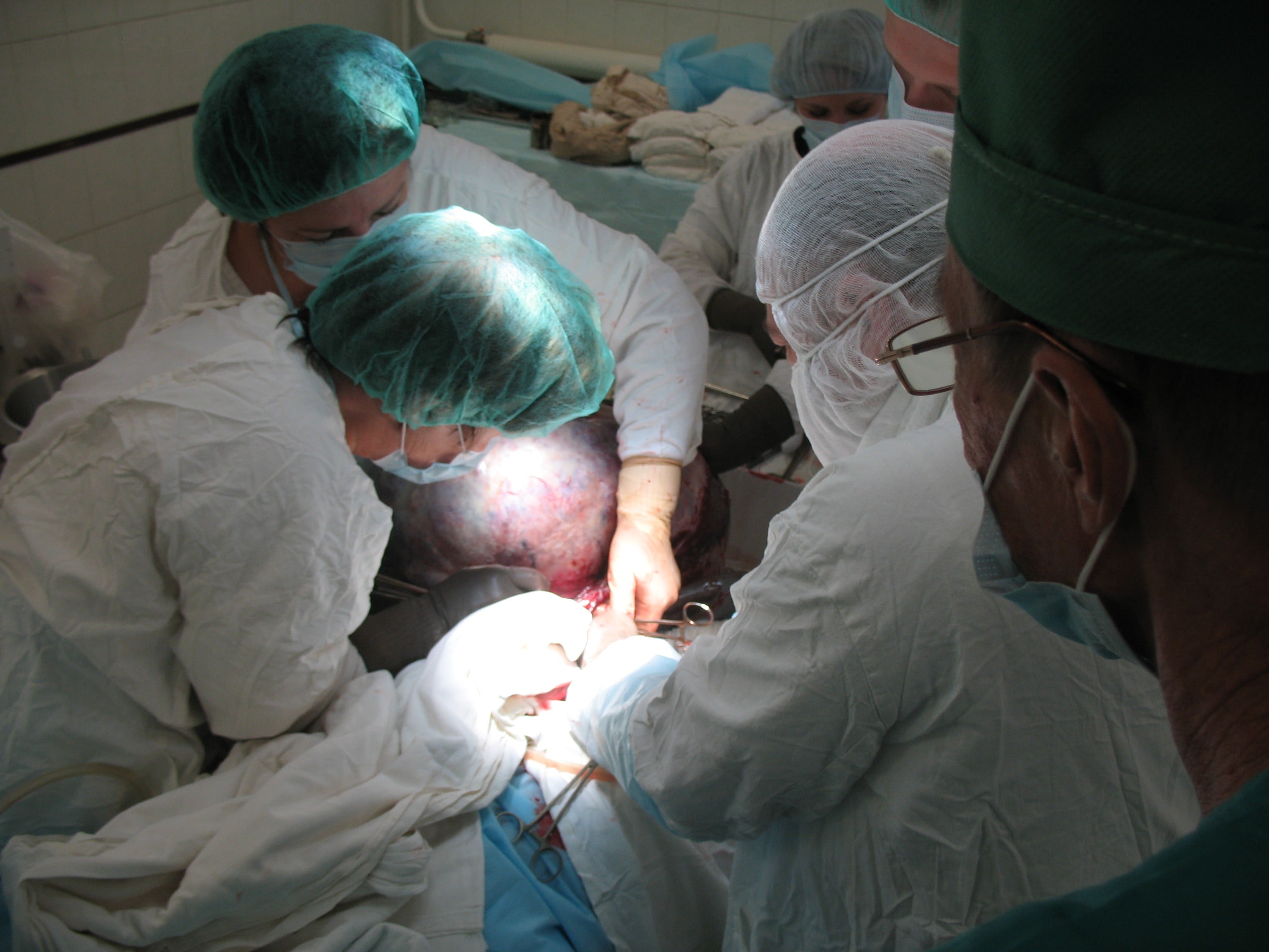 Медицина и здоровье, Томские новости, опухоль матка операция доброкачественная опухоль Томские хирурги удалили 22-килограммовую опухоль